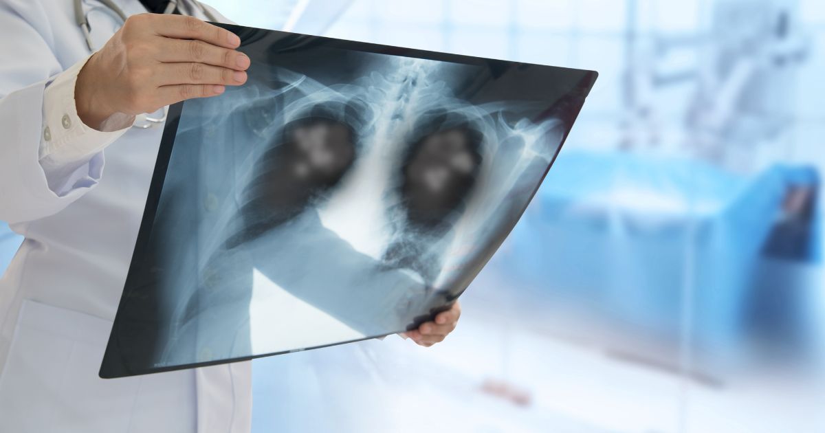 Pneumonia Symptoms and Facts