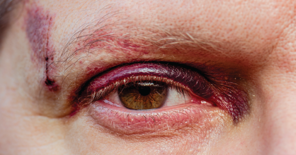injured eye and face of a man