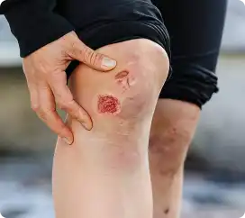 Bleeding or open wounds