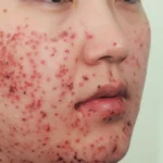 Facial skin with numerous inflamed papules and pustule lesions.