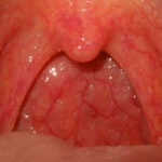 Red, inflamed throat showing possible strep infection.