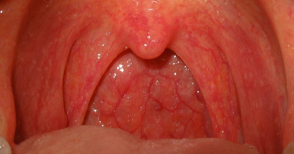 How Contagious Is Strep Throat