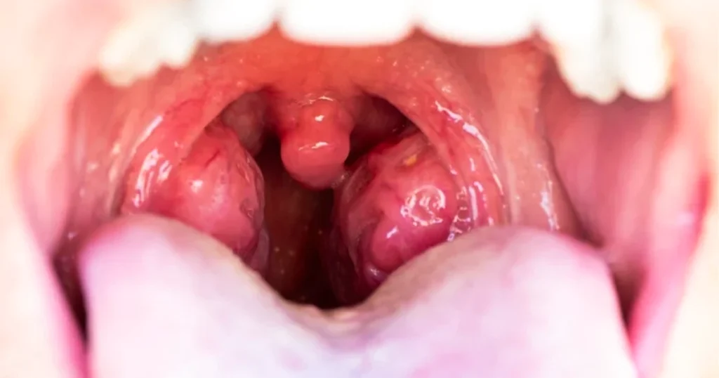 Inflamed tonsils with visible tonsil stones in throat.