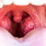 Inflamed tonsils with visible tonsil stones in throat.
