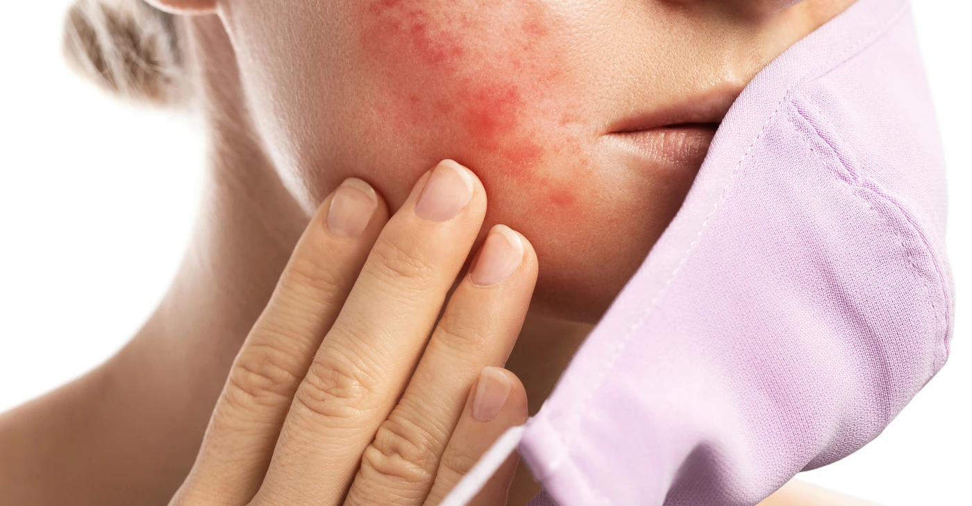 Can Skin Irritation Cause Acne