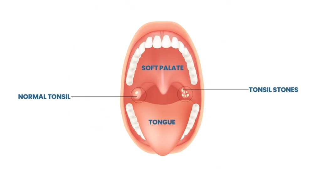 Diagram comparing normal tonsil and tonsil stones in throat.