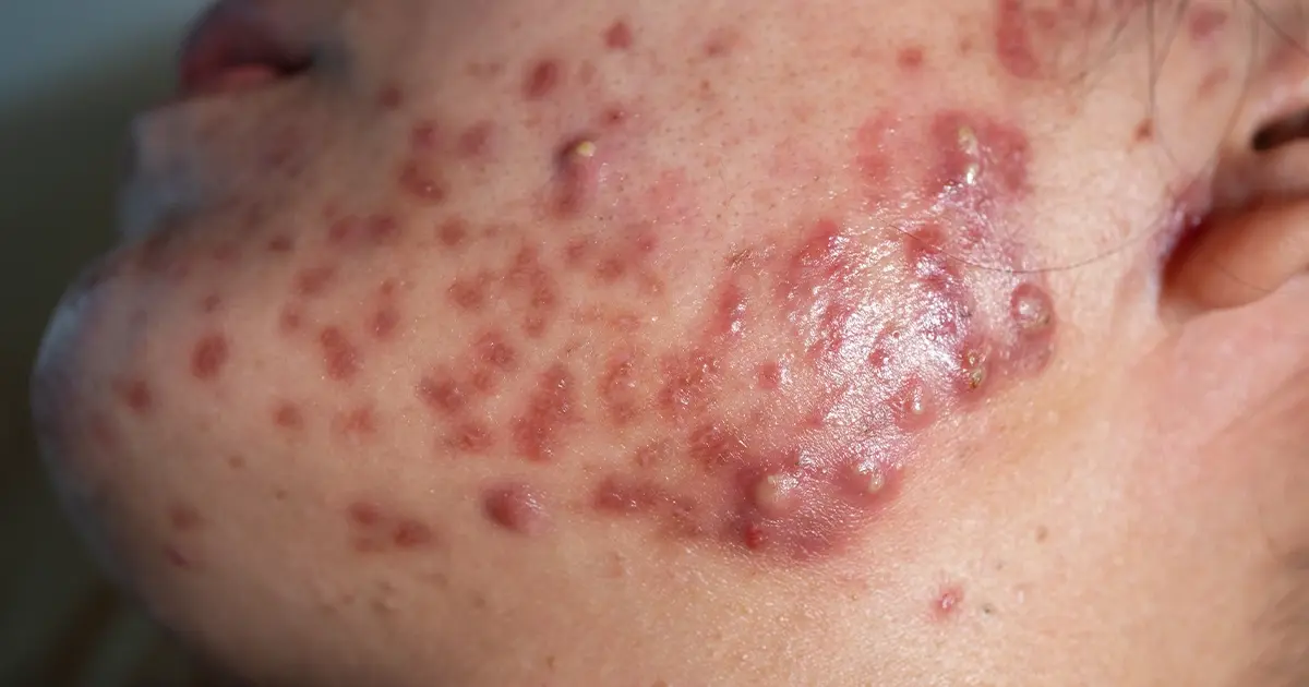 Can Skin Irritation Cause Acne