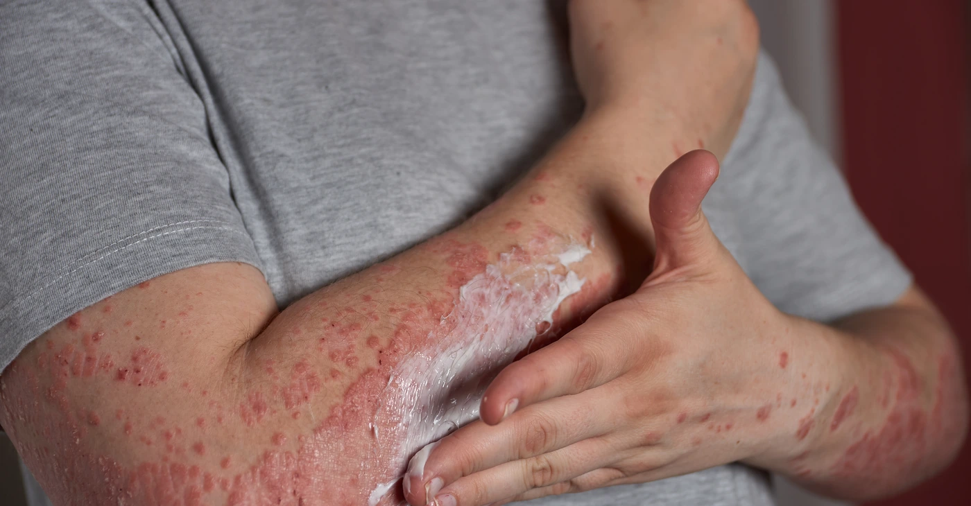 Skin Infections