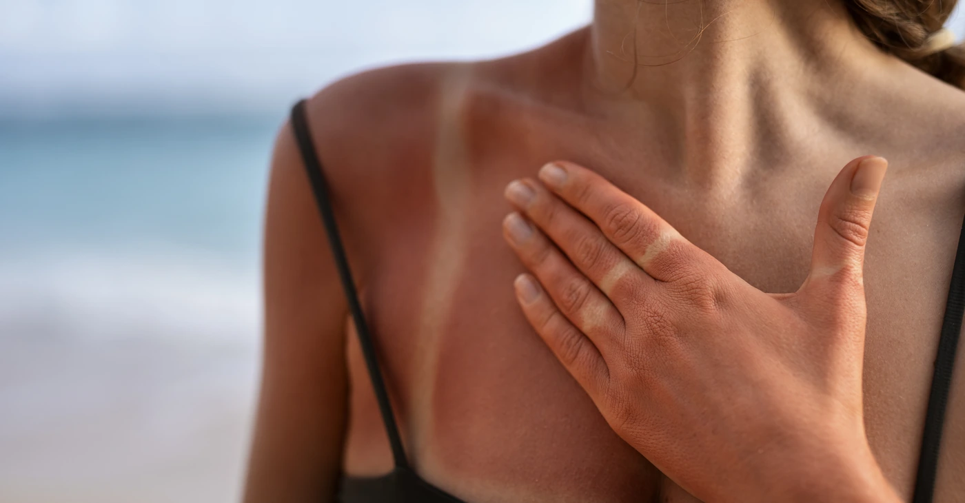 How Long Does Heat Rash Last