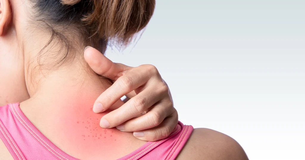 Dehydration causes headaches during outdoor heat exposure.