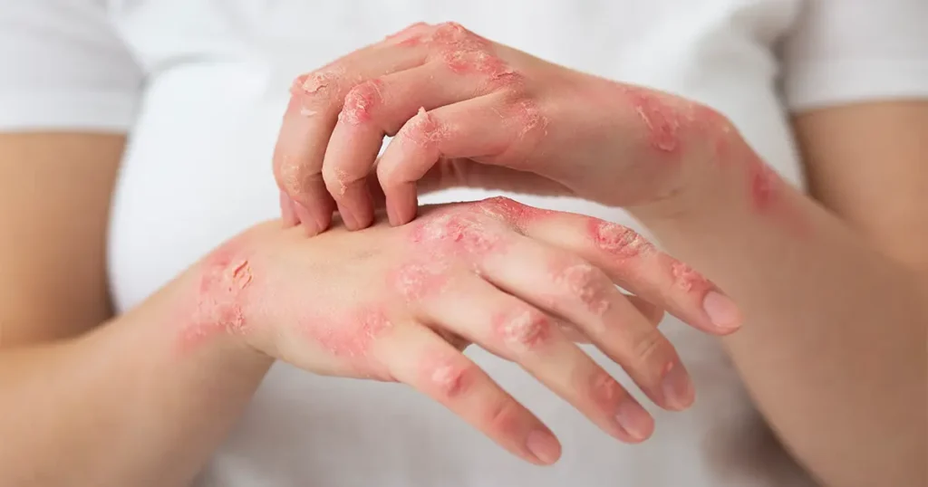 Close-up of hands with red, inflamed, dry, and peeling skin showing visible skin irritation and rash patches.