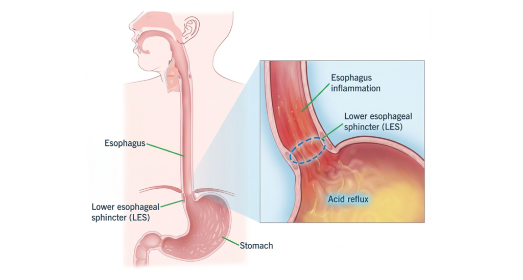Medical diagram showing acid reflux causing esophagus inflammation near the lower esophageal sphincter and stomach.
