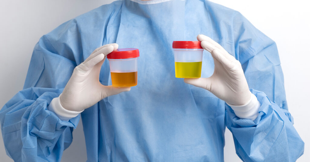 A medical professional in a blue gown and white gloves holds two plastic specimen cups filled with urine samples of different yellow shades.