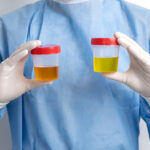A medical professional in a blue gown and white gloves holds two plastic specimen cups filled with urine samples of different yellow shades.