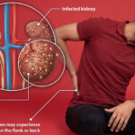 A man in pain holding his side, accompanied by an anatomical illustration highlighting an infected kidney and explaining that this condition causes flank or back pain.