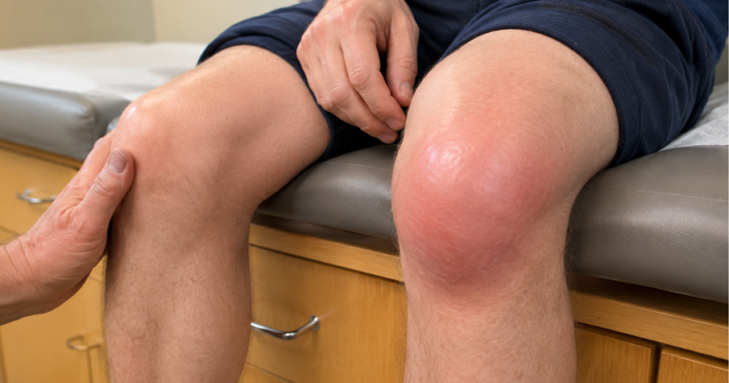 Swollen red knee with fluid buildup.