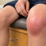 Swollen red knee with fluid buildup.