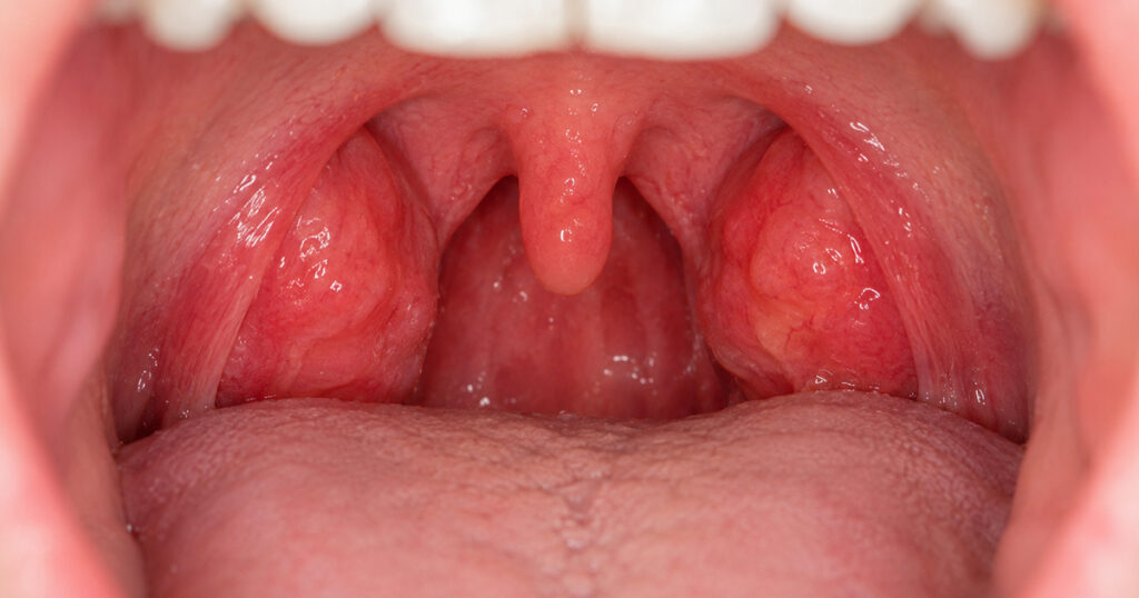 Close-up view of inflamed tonsils for throat health awareness