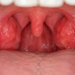 Close-up view of inflamed tonsils for throat health awareness