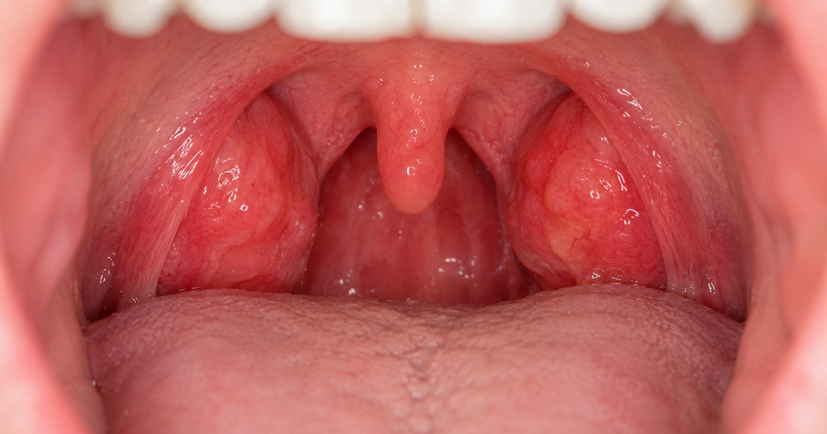 Is Tonsillitis Contagious?