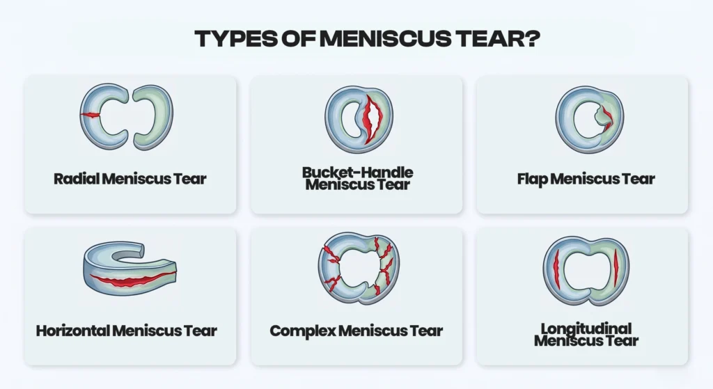 Infographic illustrating six different types of meniscus tears.