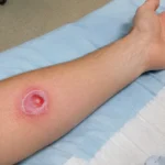 Circular inflamed skin ulcer on inner forearm.