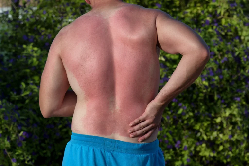 Shirtless man with a severe red sunburn on his back.