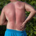 Shirtless man with a severe red sunburn on his back.