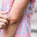 Close-up of a person scratching itchy, raised welts and mosquito bites on their arm outdoors.