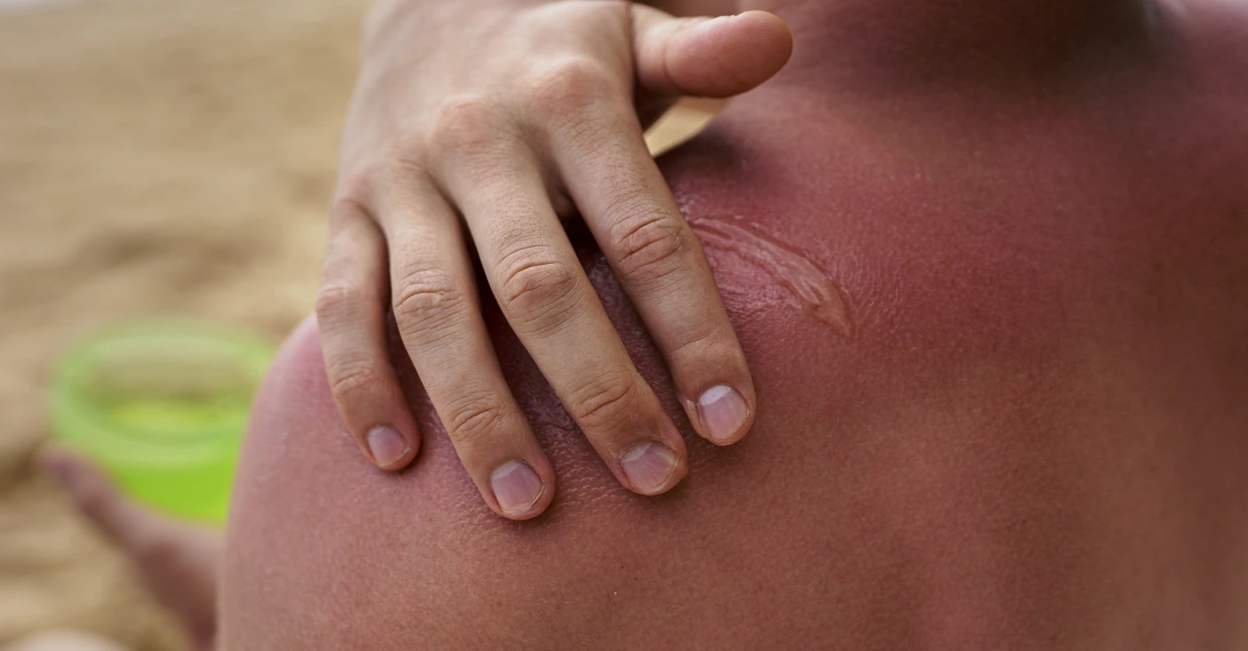 How Long Do Sunburns Last?