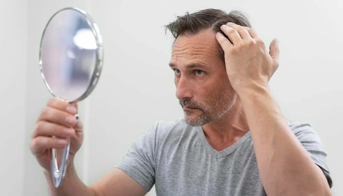 What Is Alopecia Areata​?