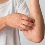 A person scratching a red, spotted skin rash on their arm.