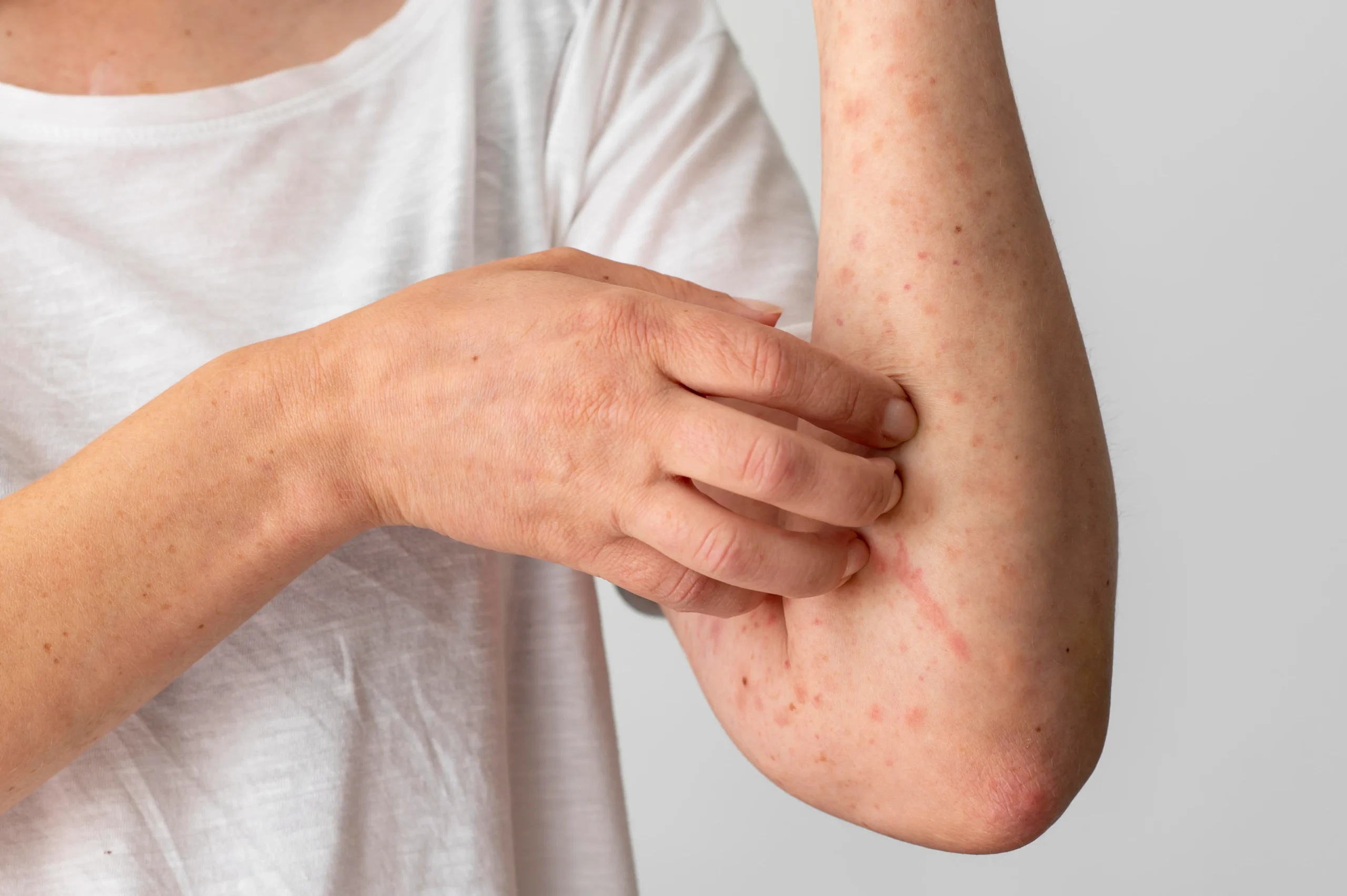 What Is Contact Dermatitis?